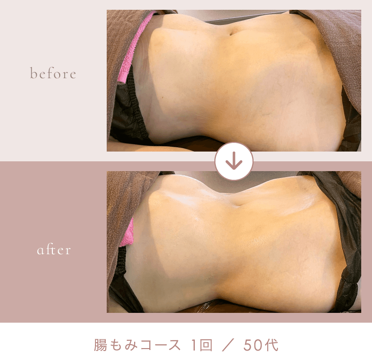 腸もみコース 1回 ／ 50代 のビフォーアフター