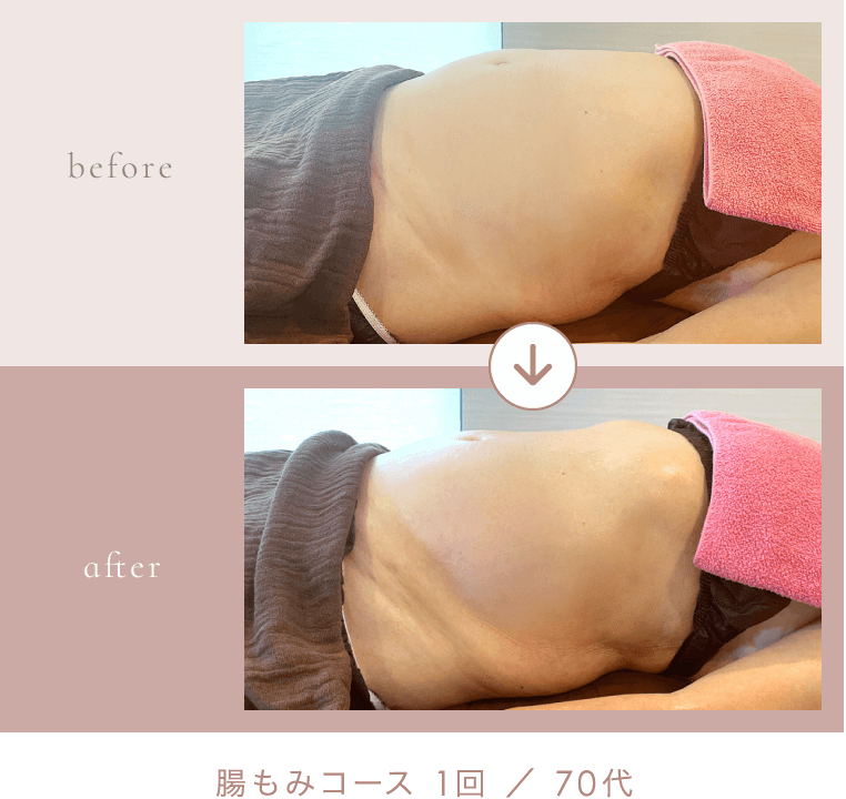 腸もみコース 1回 ／ 70代 のビフォーアフター